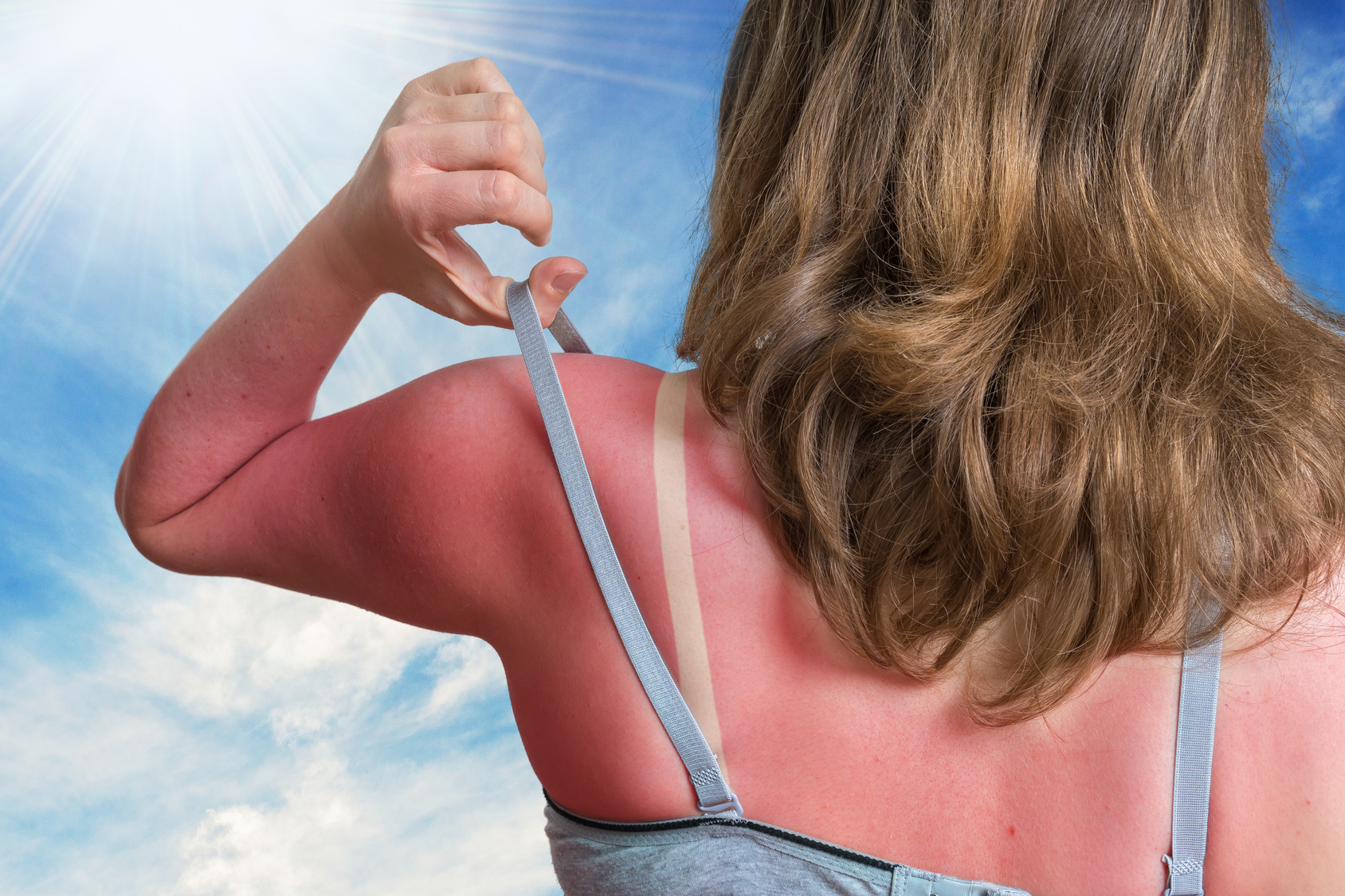 Sonne, Sommer, Kreislaufprobleme? – Sonnenbrand, Hitzschlag und Co